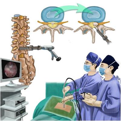 Percutaneous full-endoscopic uniportal decompression for the treatment of symptomatic idiopathic lumbar spinal epidural lipomatosis: Technical note